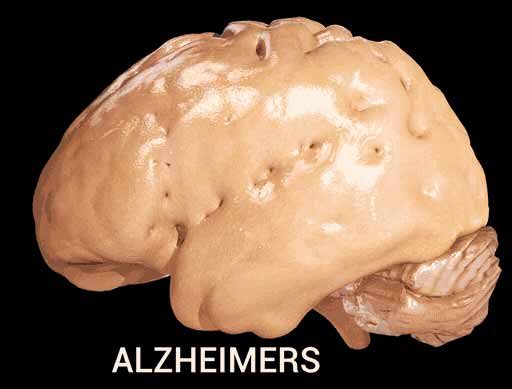 Alzheimer's disease - Cortical Atrophy.