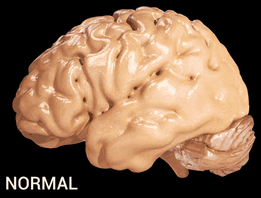 There is substantial atrophy of cortex in patients with Alzheimer's Disease, associated with loss of sulci and gyri in the parietal lobe and temporal lobe, and parts of the cingulate gyrus and frontal cortex. 